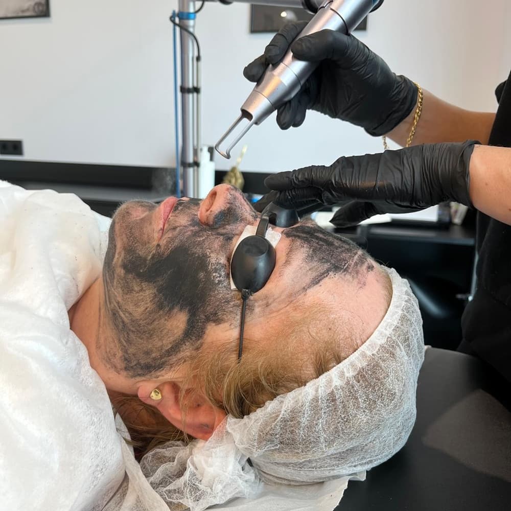 Hollywood peeling