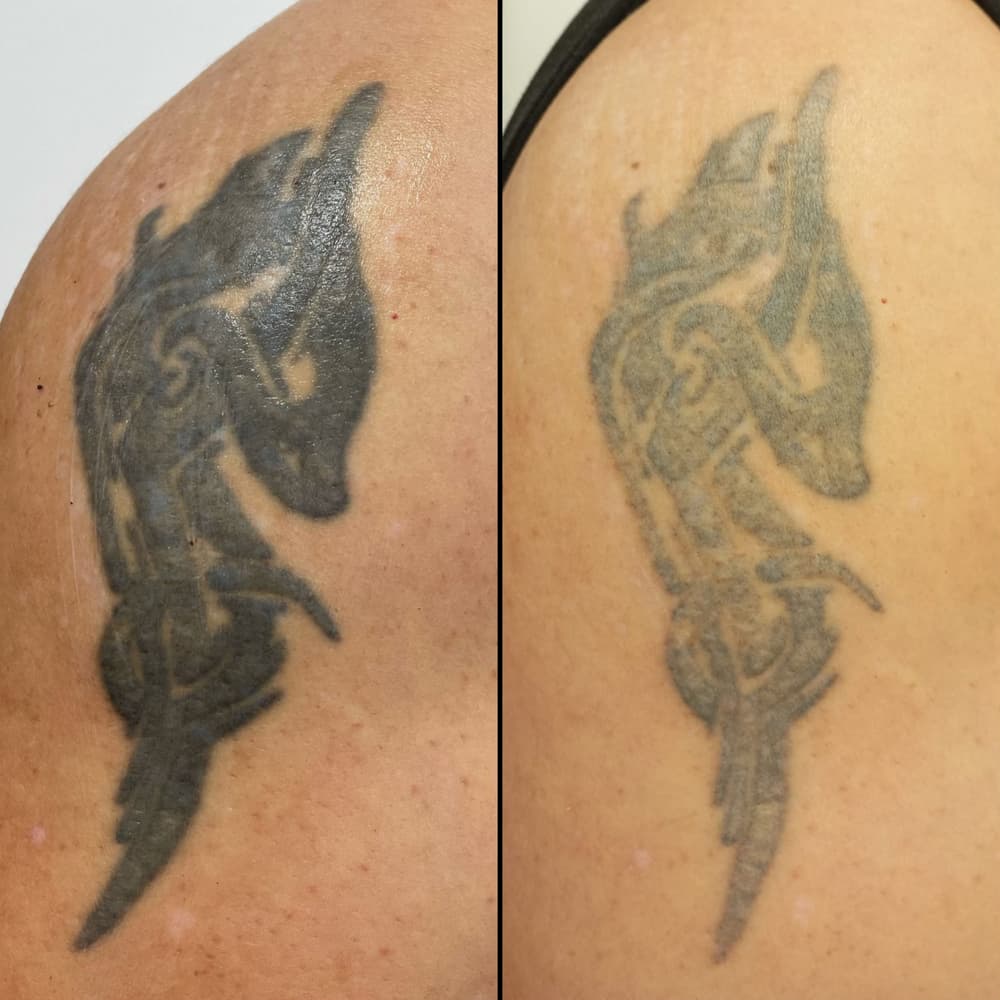 Eliminación de tatuajes